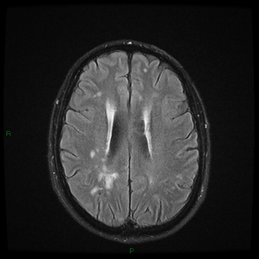 File:Cerebral amyloid angiopathy (Radiopaedia 77506-89664 Axial FLAIR 19).jpg