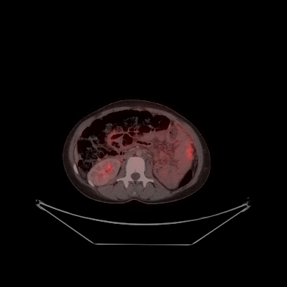 Cerebral and abdominal tuberculosis (Radiopaedia 90499-107853 C 165).jpg