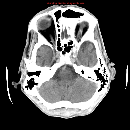 File:Cerebral and orbital tuberculomas (Radiopaedia 13308-13310 B 8).jpg