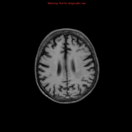 File:Cerebral and orbital tuberculomas (Radiopaedia 13308-13311 Axial T1 15).jpg