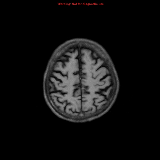 File:Cerebral and orbital tuberculomas (Radiopaedia 13308-13311 Axial T1 17).jpg