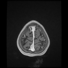 File:Cerebral and spinal tuberculosis (Radiopaedia 90489-107837 Axial T1 C+ 175).jpg
