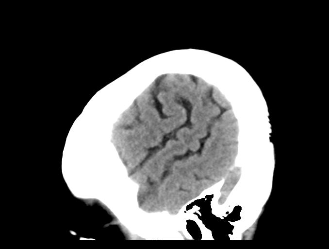 File:Cerebral aneurysm with rupture (Radiopaedia 29933-30457 B 26).jpg