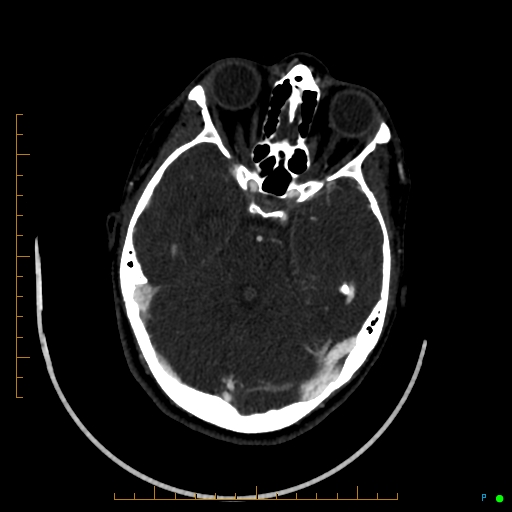 Cerebral arteriovenous malformation (AVM) (Radiopaedia 78162-90706 Axial CTA 102).jpg