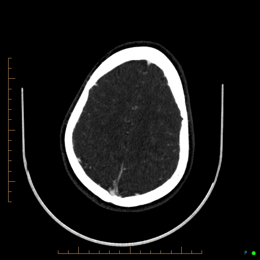 Cerebral arteriovenous malformation (AVM) (Radiopaedia 78162-90706 Axial CTA 218).jpg
