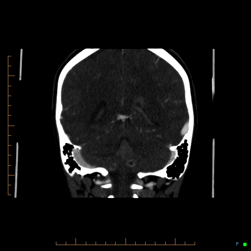 Cerebral arteriovenous malformation (AVM) (Radiopaedia 78162-90706 Coronal CTA 37).jpg