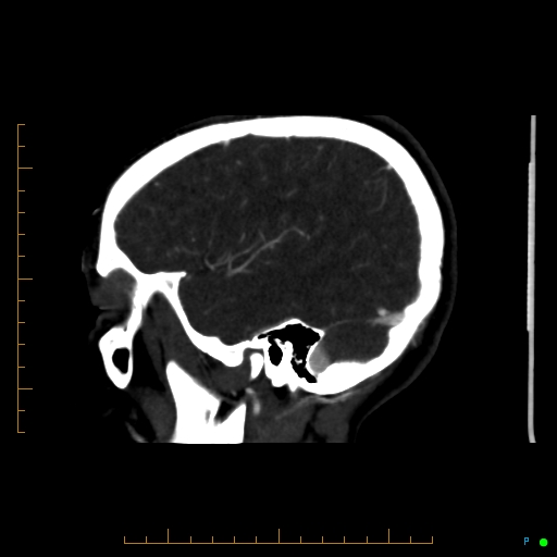 Cerebral arteriovenous malformation (AVM) (Radiopaedia 78162-90706 Sagittal CTA 62).jpg