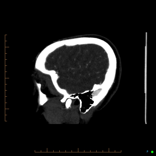 Cerebral arteriovenous malformation (AVM) (Radiopaedia 78162-90706 Sagittal CTA 67).jpg