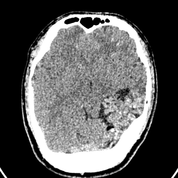 Cerebral arteriovenous malformation (Radiopaedia 37182-39012 Axial non-contrast 21).jpg