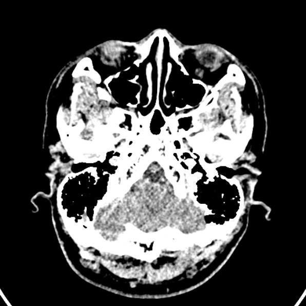 Cerebral arteriovenous malformation (Radiopaedia 37182-39012 Axial non-contrast 6).jpg
