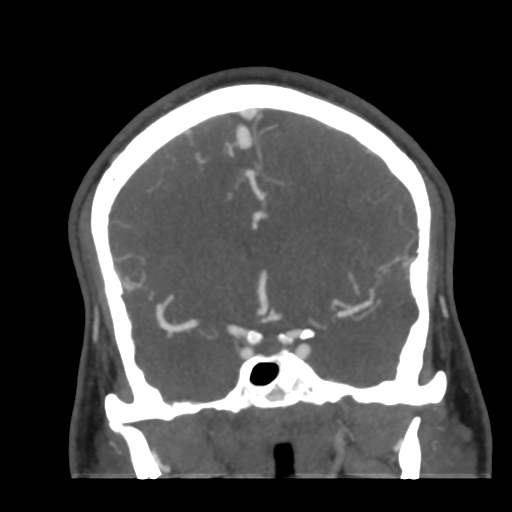 Cerebral arteriovenous malformation (Radiopaedia 39259-41505 E 27).png