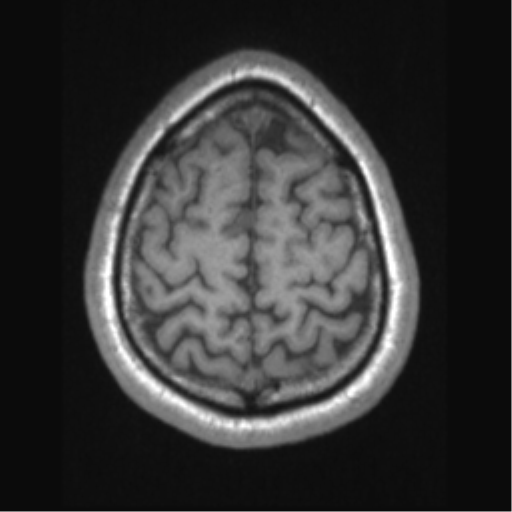 Cerebral arteriovenous malformation (Radiopaedia 39259-41506 Axial T1 65).png
