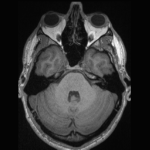File:Cerebral arteriovenous malformation (Radiopaedia 55798-62372 Axial T1 15).png