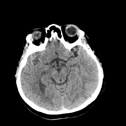 File:Cerebral arteriovenous malformation (Radiopaedia 73830-84645 Axial non-contrast 19).jpg