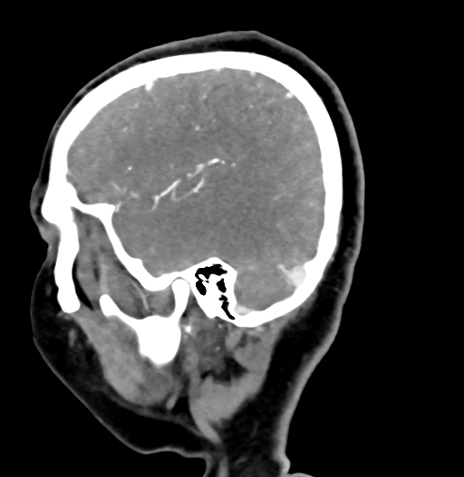 Cerebral arteriovenous malformation (Radiopaedia 73830-84645 D 20).jpg