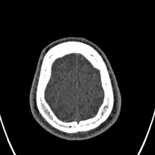Cerebral arteriovenous malformation (Radiopaedia 78188-90746 Axial non-contrast 160).jpg