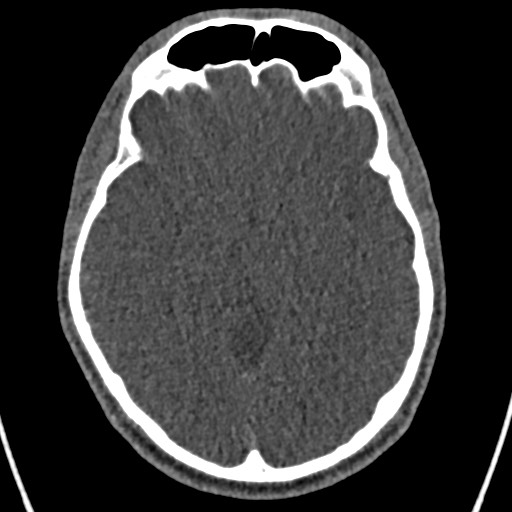 Cerebral arteriovenous malformation (Radiopaedia 78188-90746 Axial non-contrast 78).jpg