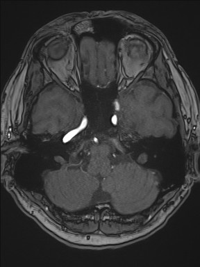 Cerebral arteriovenous malformation (Radiopaedia 84015-99245 Axial TOF 73).jpg