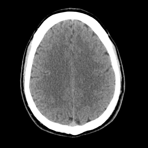 Cerebral arteriovenous malformation (Spetzler-Martin grade 2) (Radiopaedia 41262-44076 Axial non-contrast 39).png