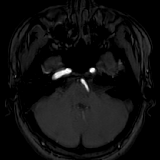 Cerebral arteriovenous malformation at posterior body of corpus callosum (Radiopaedia 74111-84925 Axial MRA 39).jpg