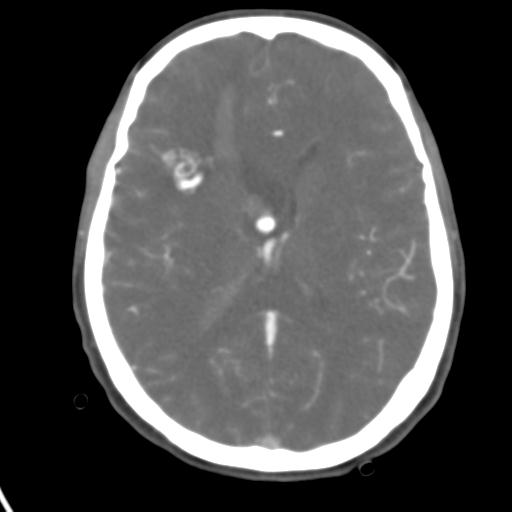 Cerebral arteriovenous malformation with hemorrhage (Radiopaedia 28773-29073 A 25).jpg