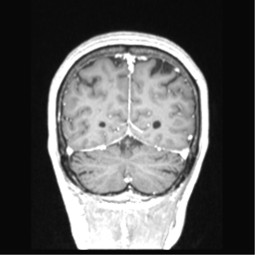 Cerebral arteriovenous malformation with hemorrhage (Radiopaedia 34422-35737 Coronal T1 C+ 22).png