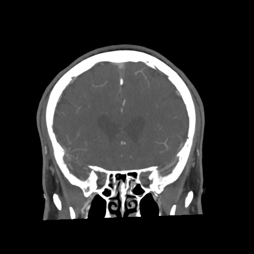 Cerebral arteriovenous malformation with lobar hemorrhage (Radiopaedia 35598-57216 C 31).jpg