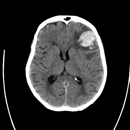 File:Cerebral arteriovenous malformation with lobar hemorrhage (Radiopaedia 44725-48512 Axial non-contrast 20).png