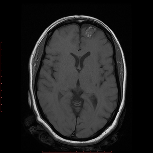 File:Cerebral cavernous malformation (Radiopaedia 26177-26306 Axial T1 11).jpg