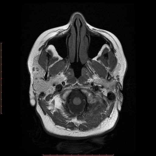 File:Cerebral cavernous malformation (Radiopaedia 26177-26306 Axial T1 3).jpg