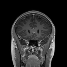 Cerebral cavernous venous malformation (Radiopaedia 70008-80021 Coronal T1 C+ 44).jpg