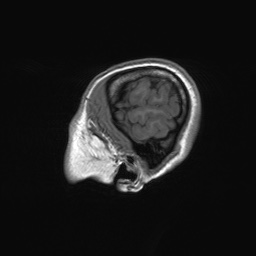 File:Cerebral cavernous venous malformation (Radiopaedia 70008-80021 Sagittal T1 6).jpg
