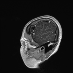 File:Cerebral cavernous venous malformation (Radiopaedia 70008-80021 Sagittal T1 C+ 8).jpg