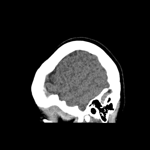 File:Cerebral cavernous venous malformation (Radiopaedia 70008-80022 C 50).jpg