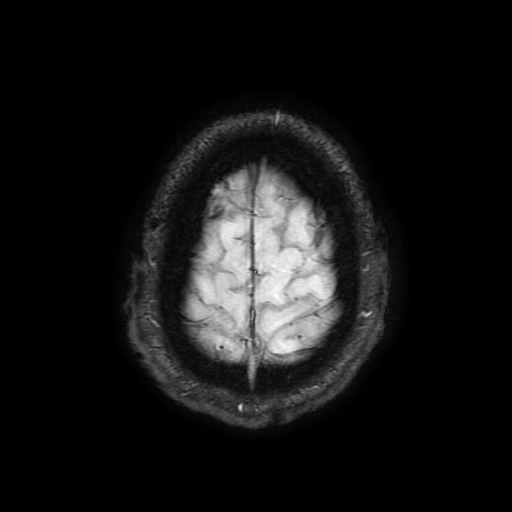 Cerebral cavernous venous malformation (Zabramski type II) (Radiopaedia 85511-101198 Axial SWI 106).jpg