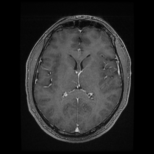 Cerebral cavernous venous malformation (Zabramski type II) (Radiopaedia 85511-101198 Axial T1 C+ fat sat 41).jpg