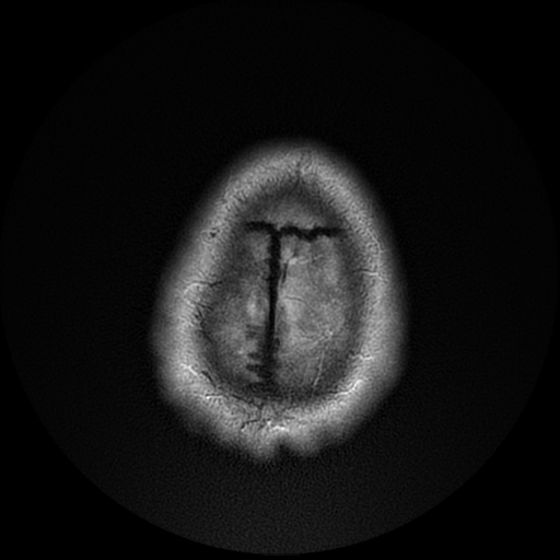 File:Cerebral cavernous venous malformation (Zabramski type II) (Radiopaedia 85511-101198 Axial T2 30).jpg