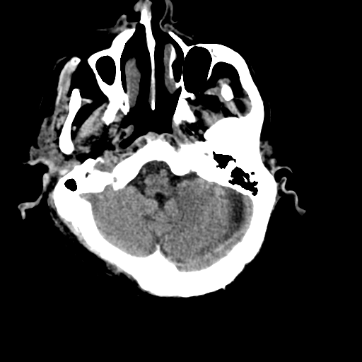 File:Cerebral contusions, subarachnoid hemorrhage and subdural hygromas (Radiopaedia 55399-61830 Axial non-contrast 6).png