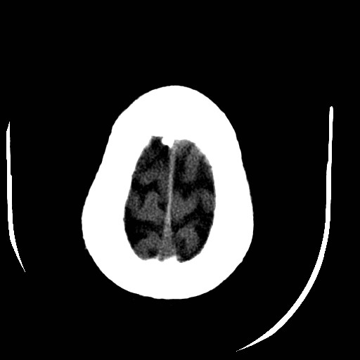 Cerebral edema (evolution in time) (Radiopaedia 19418-19440 non-contrast 85).jpg