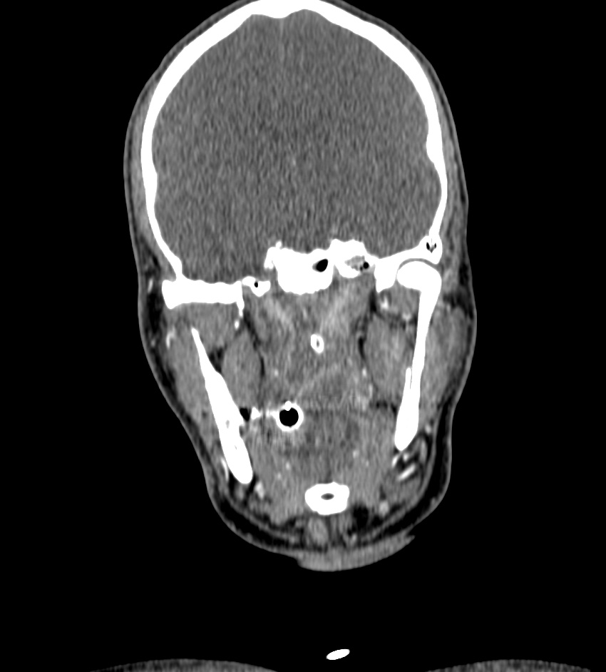Cerebral edema in an overdose patient (Radiopaedia 72005-82539 B 35).jpg