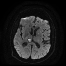 Cerebral embolic infarcts (embolic shower) (Radiopaedia 49837-55108 Axial DWI 70).jpg