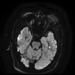 Cerebral embolic infarcts (embolic shower) (Radiopaedia 49837-55108 Axial DWI 80).jpg