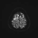 Cerebral embolic infarcts (embolic shower) (Radiopaedia 72391-82921 Axial DWI 57).jpg