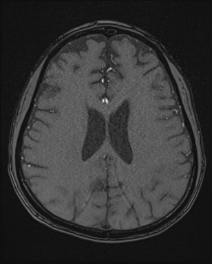 Cerebral embolic infarcts (embolic shower) (Radiopaedia 72391-82921 Axial MRA 131).jpg
