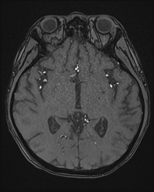Cerebral embolic infarcts (embolic shower) (Radiopaedia 72391-82921 Axial MRA 80).jpg