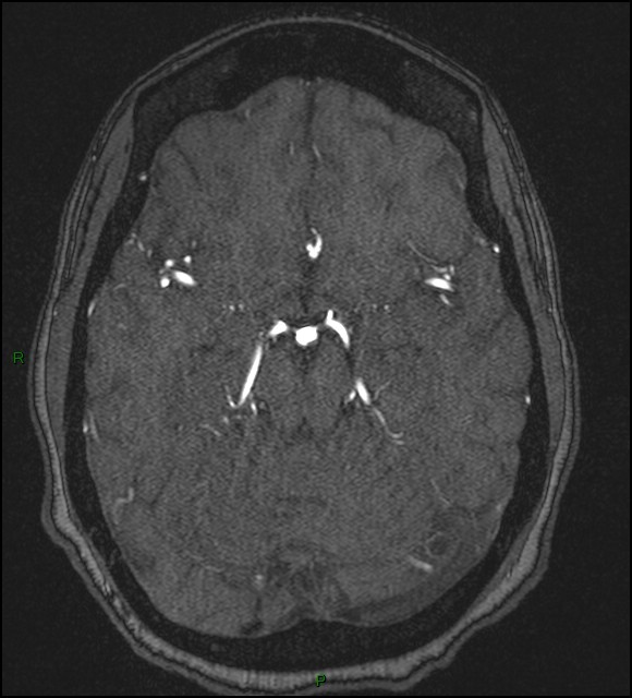 Cerebral fat embolism (Radiopaedia 35022-36525 Axial TOF 78).jpg