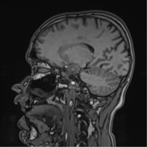 File:Cerebral fat embolism (Radiopaedia 57697-64639 Sagittal T1 31).png