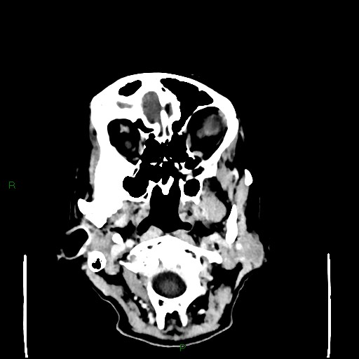 Cerebral metastases - breast primary (Radiopaedia 77653-89857 Axial C+ delayed 12).jpg