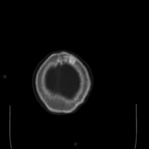 Cerebral metastases - breast primary (Radiopaedia 77653-89857 Axial bone window 110).jpg