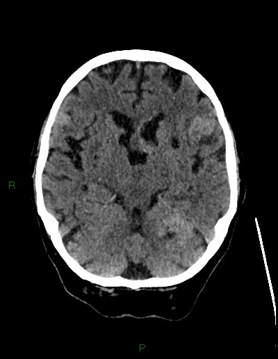 Cerebral metastases - ependymal and parenchymal (Radiopaedia 79877-93131 Axial non-contrast 28).jpg
